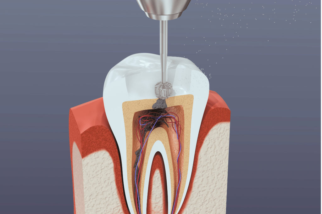 Endodontic Treatment and Root Canal Virginia
