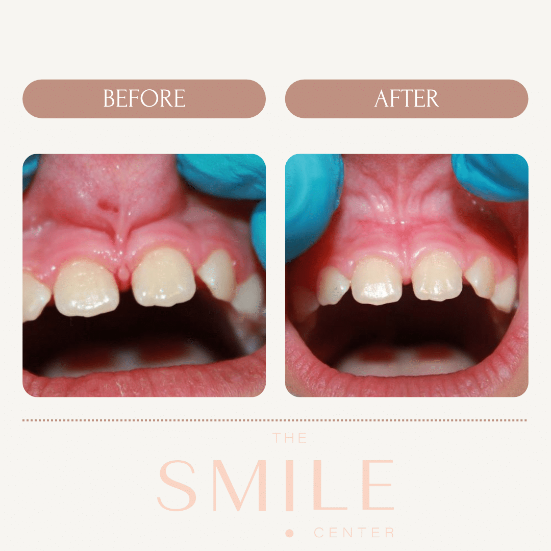 Lip and Tongue-Tie Treatment Virginia